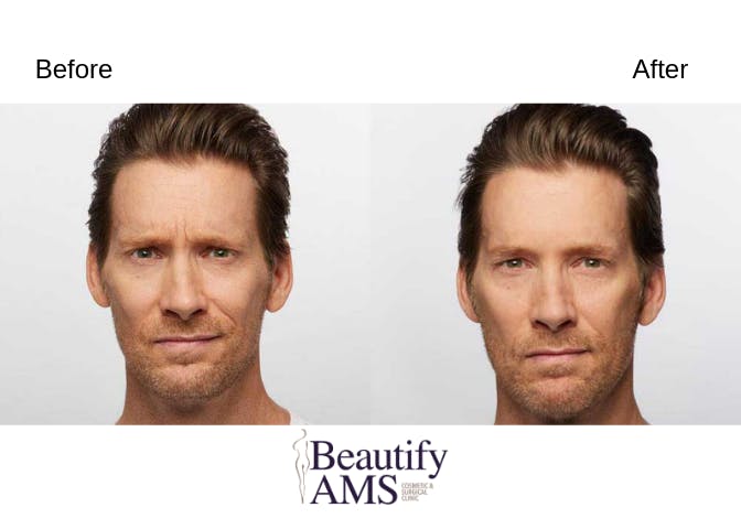 BroTox Before & After Gallery - Patient 123746014 - Image 1