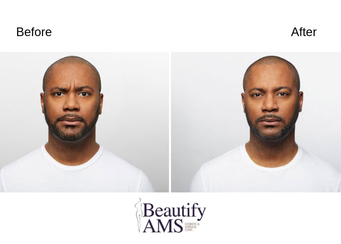 BroTox Before & After Gallery - Patient 123746013 - Image 1