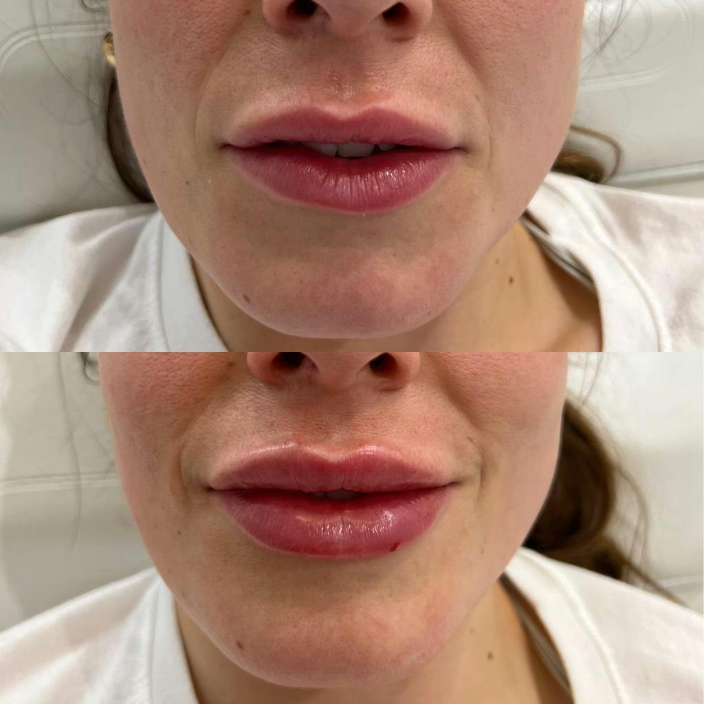 Lip Enhancement  Before & After Gallery - Patient 123840689 - Image 1