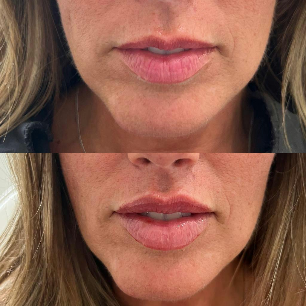 Lip Enhancement  Before & After Gallery - Patient 123840688 - Image 1