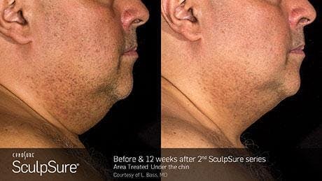 Non-Invasive Body Contouring Before & After Gallery - Patient 41897244 - Image 1