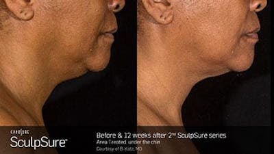 Non-Invasive Body Contouring Before & After Gallery - Patient 41897249 - Image 1