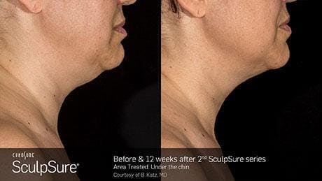 Non-Invasive Body Contouring Before & After Gallery - Patient 41897250 - Image 1