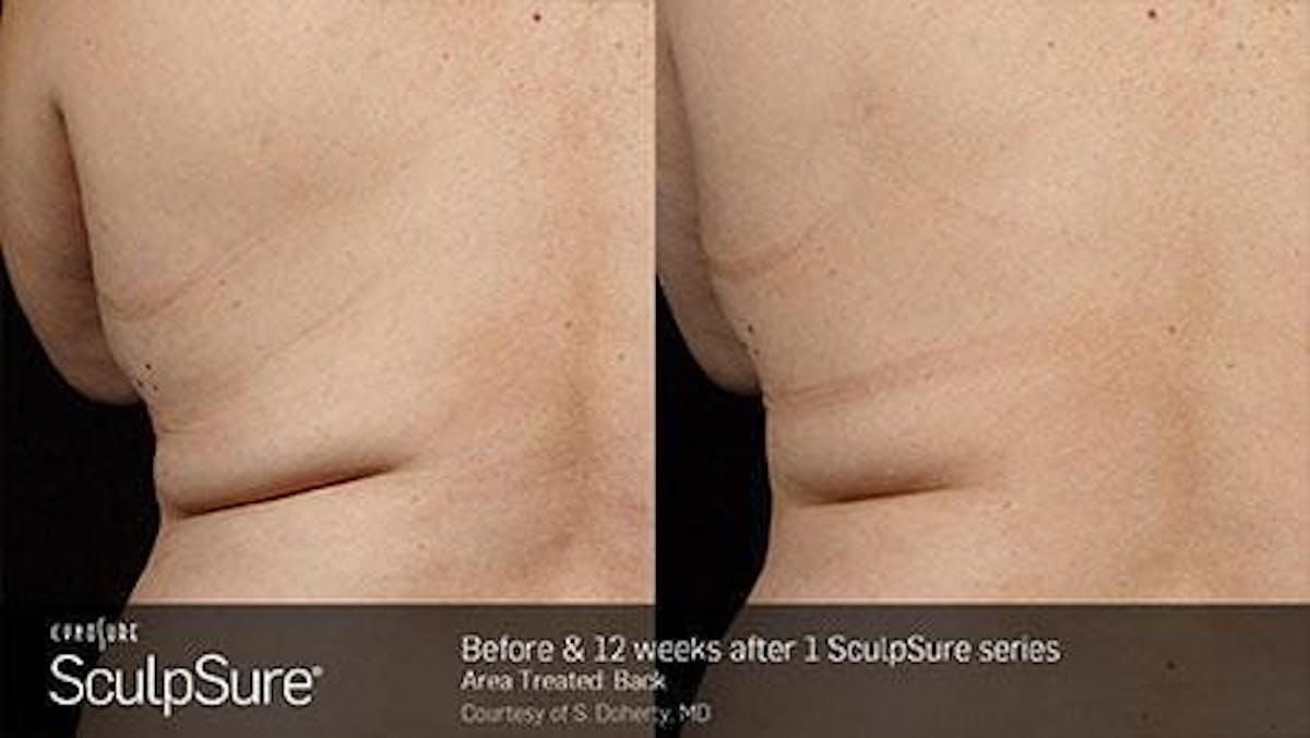 Non-Invasive Body Contouring Before & After Gallery - Patient 41897251 - Image 1