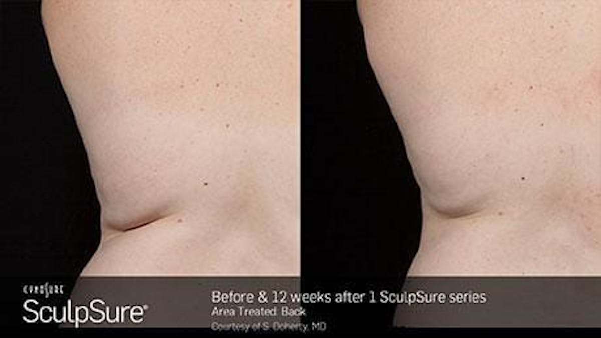 Non-Invasive Body Contouring Before & After Gallery - Patient 41897252 - Image 1