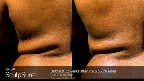 Non-Invasive Body Contouring Before & After Gallery - Patient 41897253 - Image 1