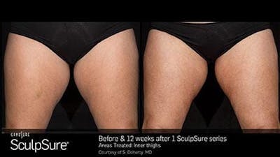 Non-Invasive Body Contouring Before & After Gallery - Patient 41897254 - Image 1