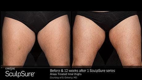 Non-Invasive Body Contouring Before & After Gallery - Patient 41897254 - Image 1