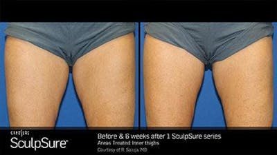 Non-Invasive Body Contouring Before & After Gallery - Patient 41897255 - Image 1