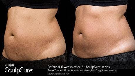 Non-Invasive Body Contouring Before & After Gallery - Patient 41897257 - Image 1