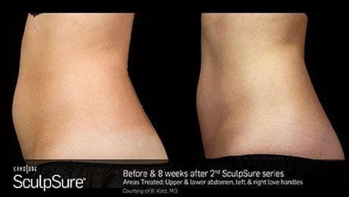 Non-Invasive Body Contouring Before & After Gallery - Patient 41897258 - Image 1