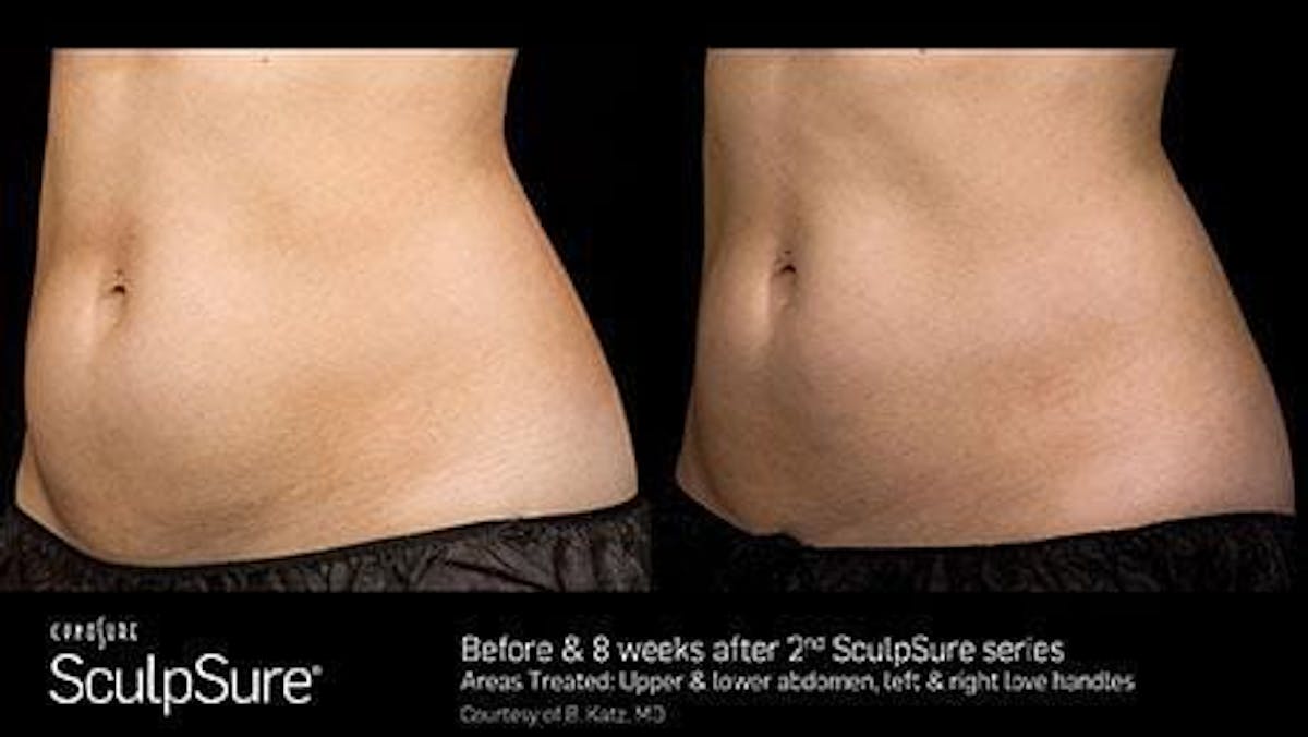 Non-Invasive Body Contouring Before & After Gallery - Patient 41897259 - Image 1