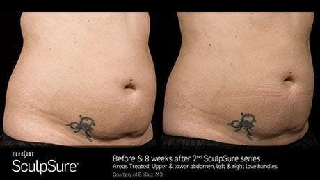 Non-Invasive Body Contouring Gallery - Patient 41897260 - Image 1