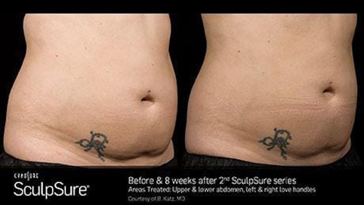 Non-Invasive Body Contouring Before & After Gallery - Patient 41897260 - Image 1