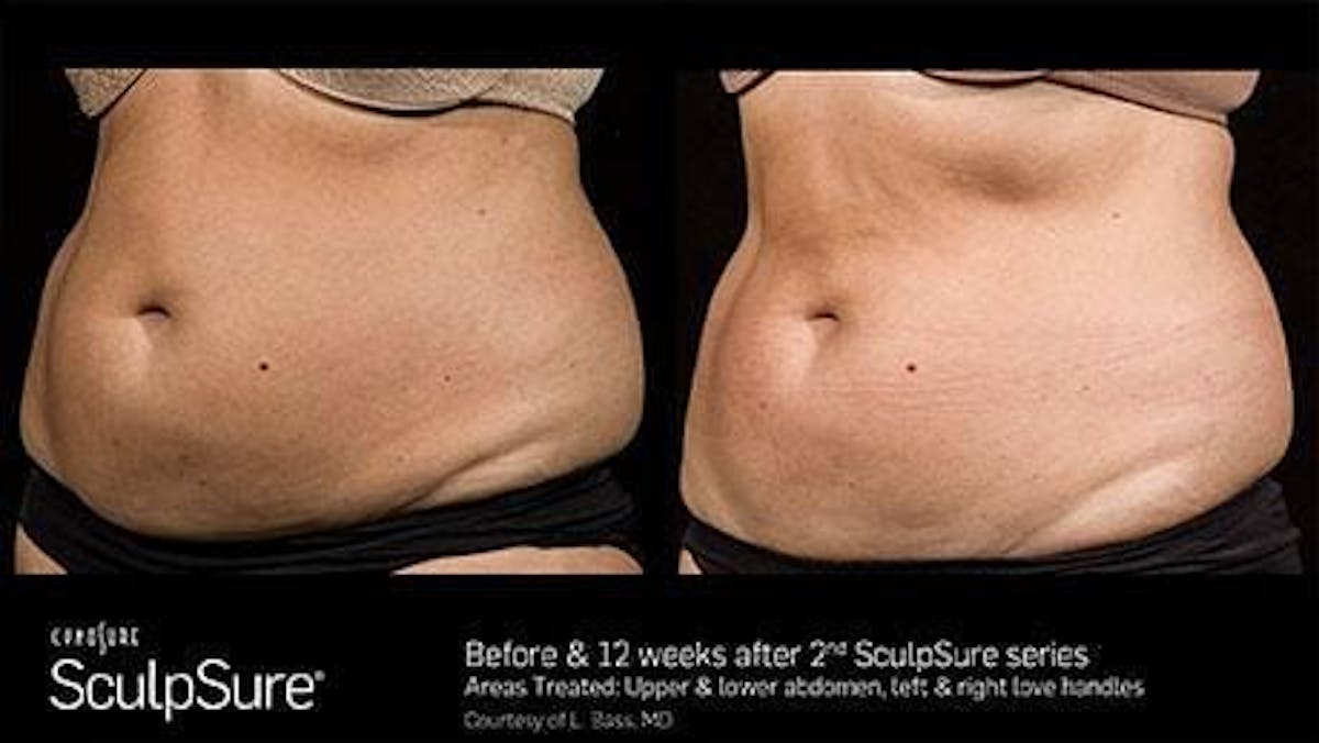 Non-Invasive Body Contouring Before & After Gallery - Patient 41897261 - Image 1