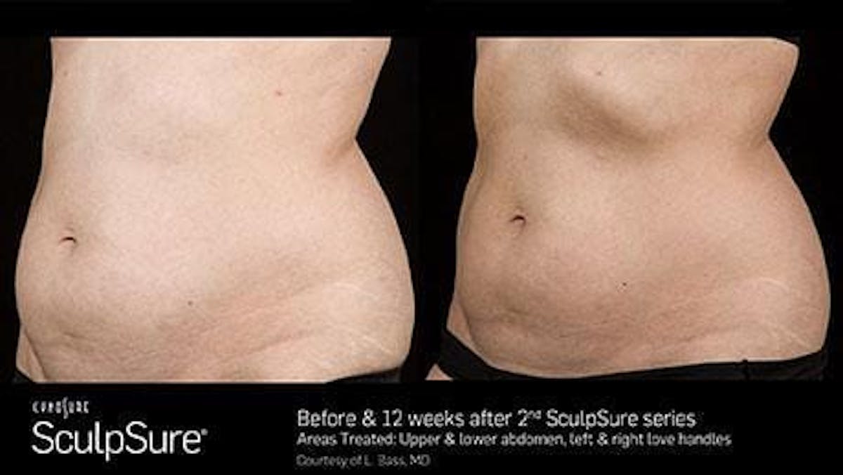 Non-Invasive Body Contouring Before & After Gallery - Patient 41897262 - Image 1