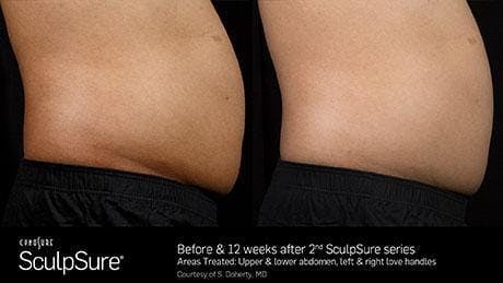 Non-Invasive Body Contouring Before & After Gallery - Patient 41897263 - Image 1