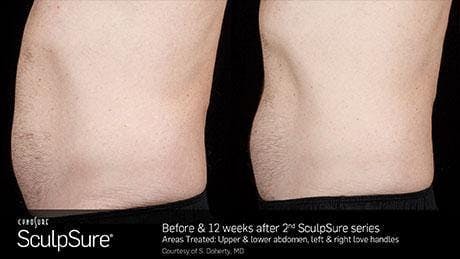 Non-Invasive Body Contouring Before & After Gallery - Patient 41897264 - Image 1