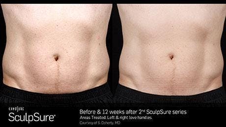 Non-Invasive Body Contouring Before & After Gallery - Patient 41897265 - Image 1