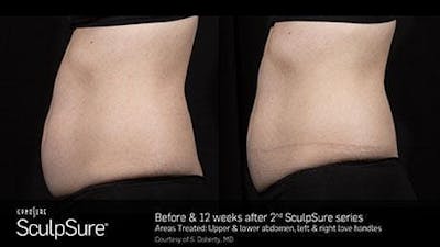 Non-Invasive Body Contouring Before & After Gallery - Patient 41897266 - Image 1