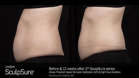Non-Invasive Body Contouring Before & After Gallery - Patient 41897266 - Image 1