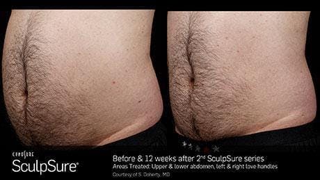 Non-Invasive Body Contouring Before & After Gallery - Patient 41897267 - Image 1