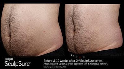 Non-Invasive Body Contouring Before & After Gallery - Patient 41897267 - Image 1