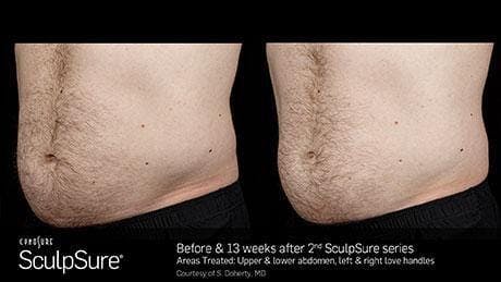 Non-Invasive Body Contouring Before & After Gallery - Patient 41897268 - Image 1