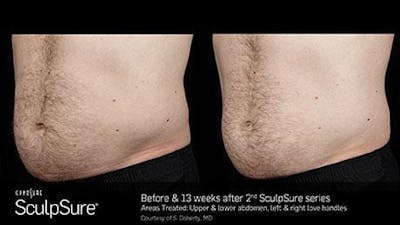 Non-Invasive Body Contouring Before & After Gallery - Patient 41897268 - Image 1