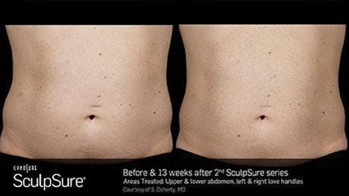 Non-Invasive Body Contouring Before & After Gallery - Patient 41897269 - Image 1
