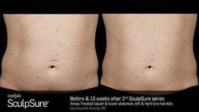 Non-Invasive Body Contouring Before & After Gallery - Patient 41897269 - Image 1