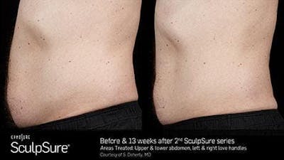 Non-Invasive Body Contouring Before & After Gallery - Patient 41897270 - Image 1