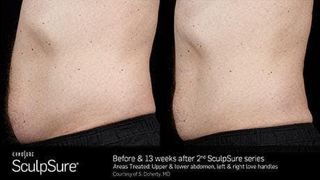 Non-Invasive Body Contouring Before & After Gallery - Patient 41897270 - Image 1