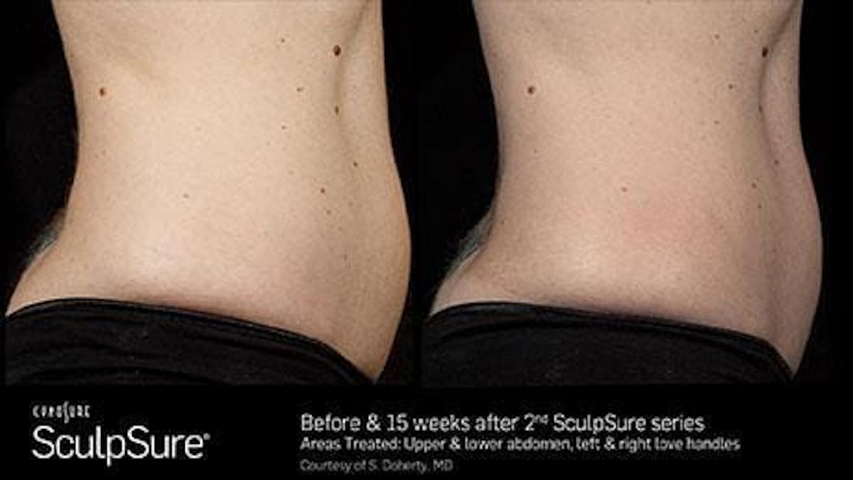 Non-Invasive Body Contouring Before & After Gallery - Patient 41897271 - Image 1