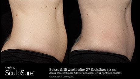 Non-Invasive Body Contouring Before & After Gallery - Patient 41897271 - Image 1