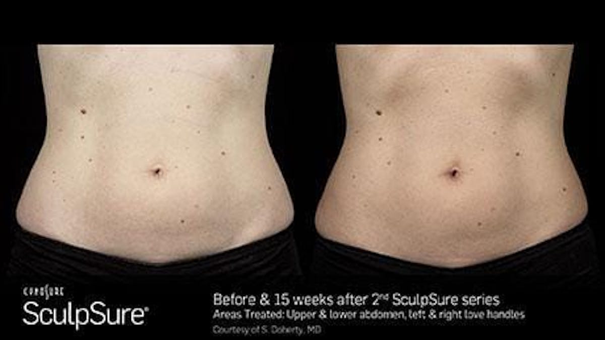 Non-Invasive Body Contouring Before & After Gallery - Patient 41897272 - Image 1