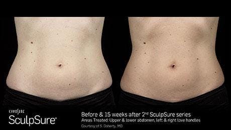 Non-Invasive Body Contouring Before & After Gallery - Patient 41897272 - Image 1
