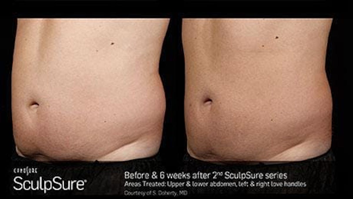 Non-Invasive Body Contouring Before & After Gallery - Patient 41897273 - Image 1