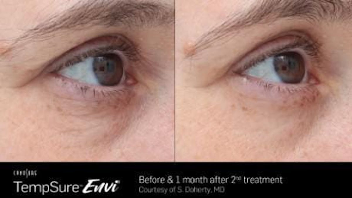 Skin Tightening Before & After Gallery - Patient 41897277 - Image 1