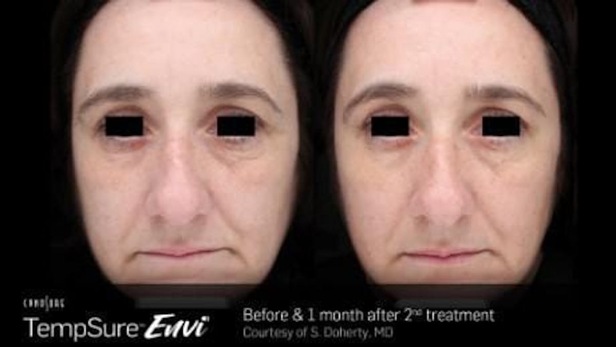 Skin Tightening Before & After Gallery - Patient 41897278 - Image 1