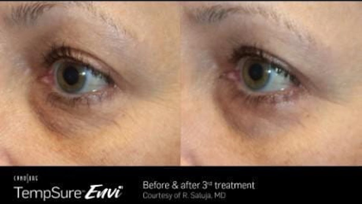 Skin Tightening Before & After Gallery - Patient 41897279 - Image 1
