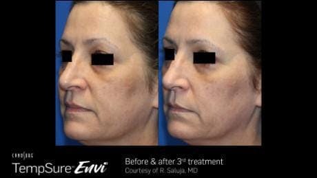 Skin Tightening Before & After Gallery - Patient 41897280 - Image 1