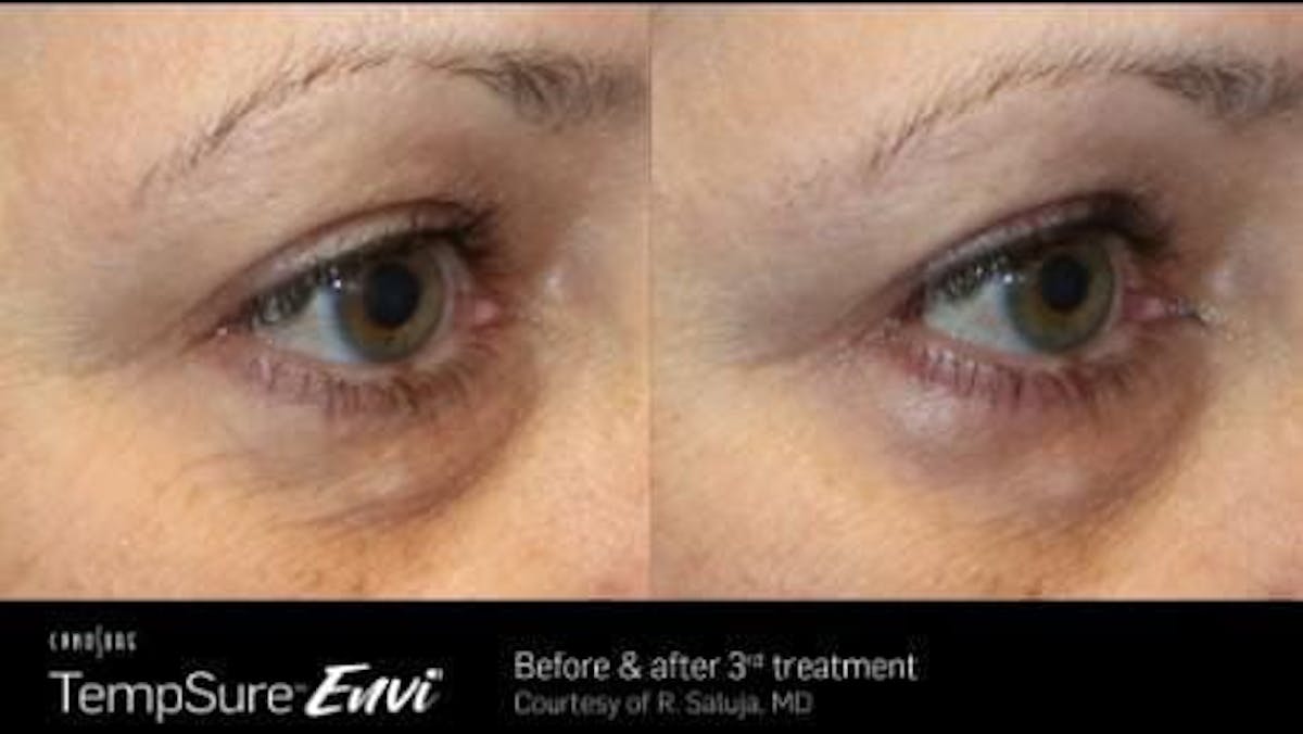 Skin Tightening Before & After Gallery - Patient 41897281 - Image 1