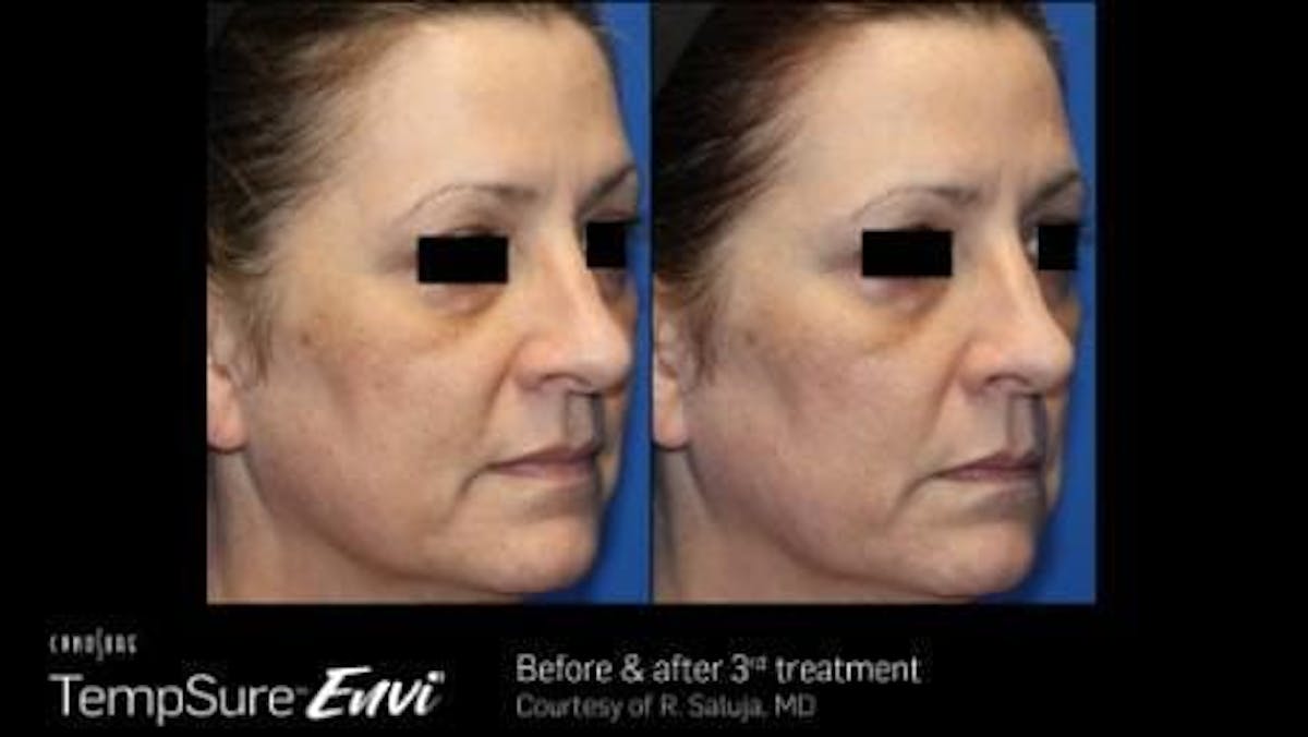 Skin Tightening Before & After Gallery - Patient 41897282 - Image 1