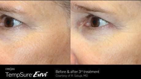 Skin Tightening Before & After Gallery - Patient 41897283 - Image 1