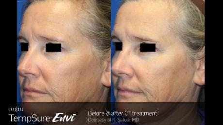 Skin Tightening Before & After Gallery - Patient 41897284 - Image 1