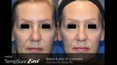 Skin Tightening Before & After Gallery - Patient 41897285 - Image 1