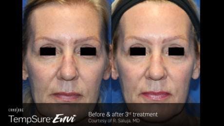 Skin Tightening Before & After Gallery - Patient 41897285 - Image 1