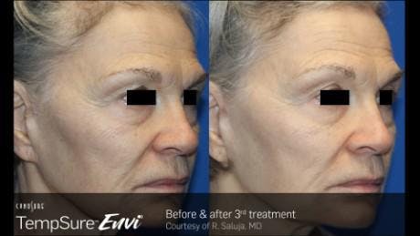 Skin Tightening Before & After Gallery - Patient 41897286 - Image 1