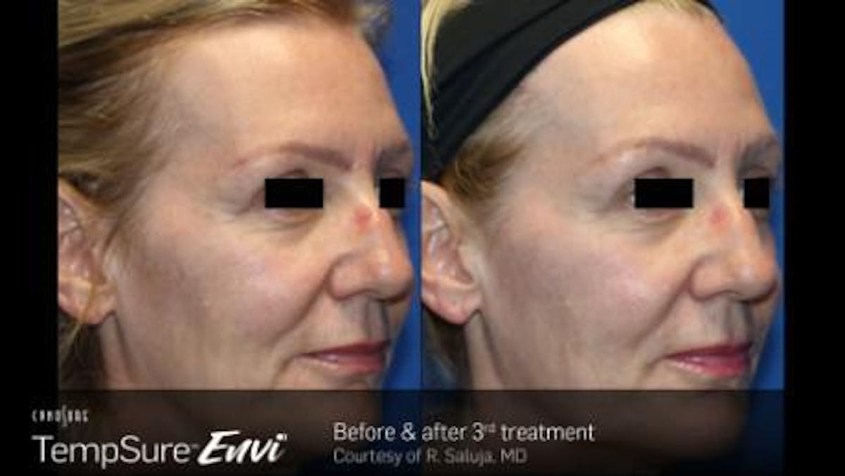 Skin Tightening Before & After Gallery - Patient 41897287 - Image 1